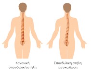 rejoin school screening scoliosis sta sxoleia tou dimou delta